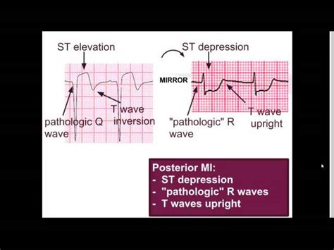 Posterior Wall Mi Is Best Identified in Which Leads