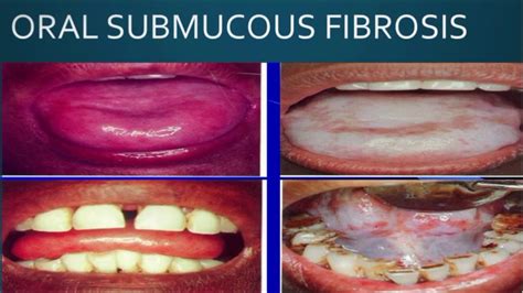 Oral Submucous Fibrosis (OSMF) - Premalignant Lesion - YouTube