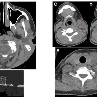 (A) axial view; the red arrow shows edematous torus tubarius; compared... | Download Scientific ...