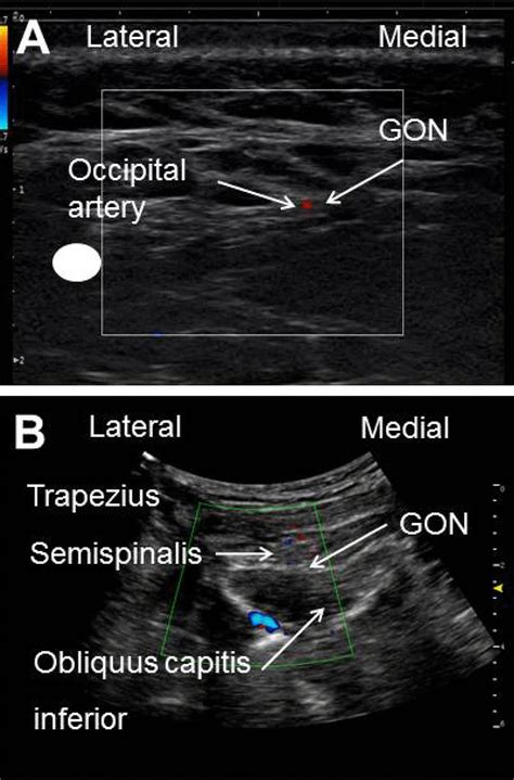 15 Ultrasound Identification Of The Greater Occipital Nerve A Images ...