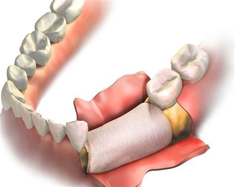 Guided Bone Regeneration / Guided Tissue Regeneration – Dr Eric Battista