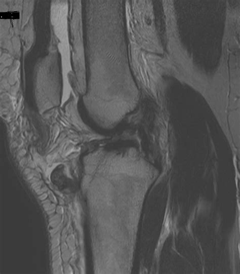 Patellar Tendon Rupture-MRI - Sumer's Radiology Blog