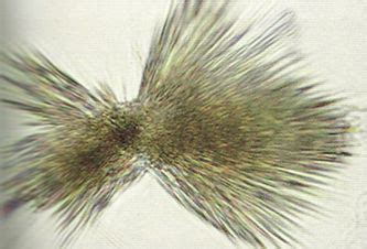 Tyrosine crystals can be seen in urine in tyrosenimia along with ...