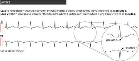 Atrioventricular nodal reentry tachycardia (AVNRT) – ECG learning