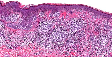 Pathology Outlines - Invasive melanoma