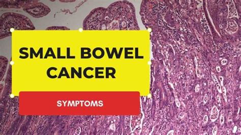 Be Careful With These 8+ Small Bowel Cancer Symptoms