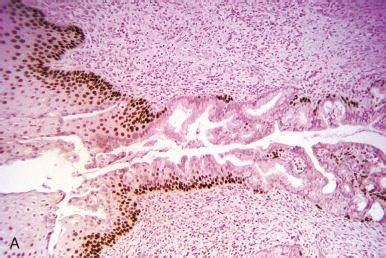 Altered Endometrial Differentiation (Metaplasia) - Clinical Tree