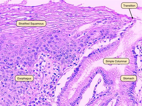 Barretts Esophagus Histology