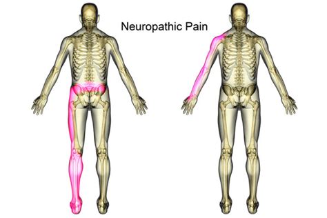 Neuropathic Pain Symptoms & Treatment - Psychiatry Advisor