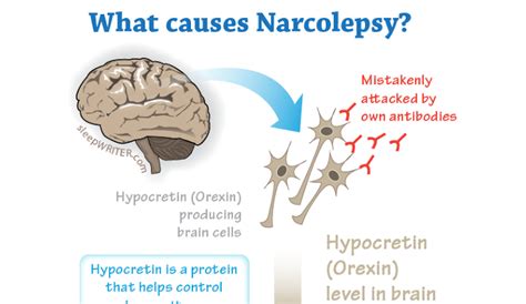 Famous People with Narcolepsy - HRF