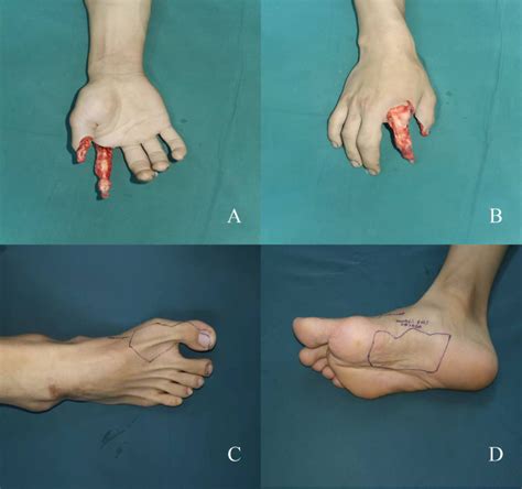 Combined great toe dorsal nail-skin flap and medial plantar flap for one-stage reconstruction of ...