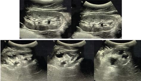 Fetal Hydronephrosis Grading