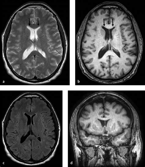 3 Asymmetry of the Lateral Ventricles | Radiology Key