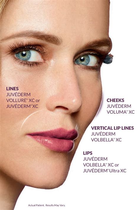 Juvederm Collection of Dermal Fillers | Concierge Aesthetics, Irvine