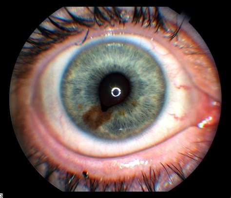 Iris Nevus - Retina Image Bank