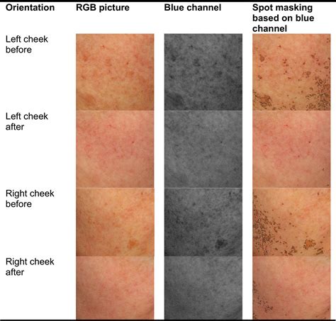 Treatment of solar lentigines using a combination of picosecond laser ...