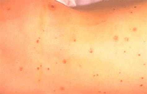 Meningitis – Symptoms, Treatment, Causes, Rash Pictures | hubpages