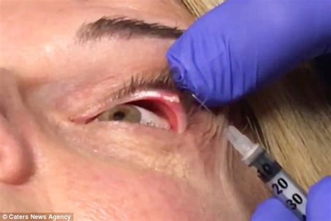 California doctor pops a stye next to patient's eyeball | Daily Mail Online