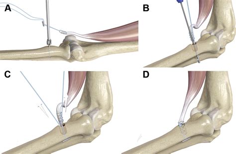 Surgical Treatment of Distal Biceps Ruptures - Orthopedic Clinics