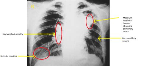 Blastomycosis chest x ray - wikidoc