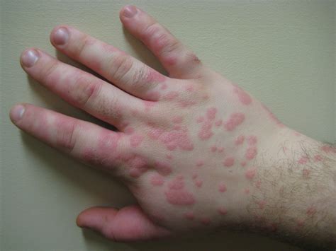 Treatment for Shingles Rash - FastMed