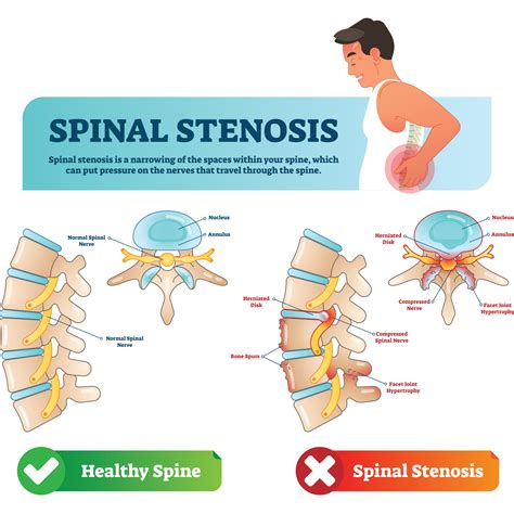 What is Spinal Stenosis? | Fast Relief Acupuncture