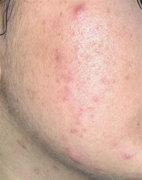 [Acne] Is my skin dehydrated? Recommendations welcomed! : SkincareAddiction