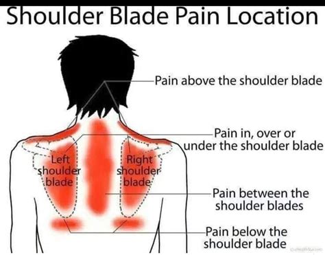 Awasome Pinched Nerve In Shoulder Blade Treatment At Home 2022