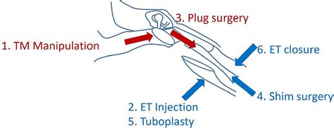 Management of Patulous Eustachian Tube | JMA Journal