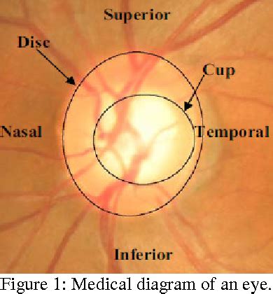 Figure 1 from Enhancement of optic cup to disc ratio detection in glaucoma diagnosis | Semantic ...