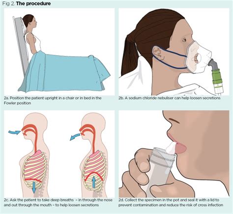 Specimen collection 4: procedure for obtaining a sputum specimen | Nursing Times