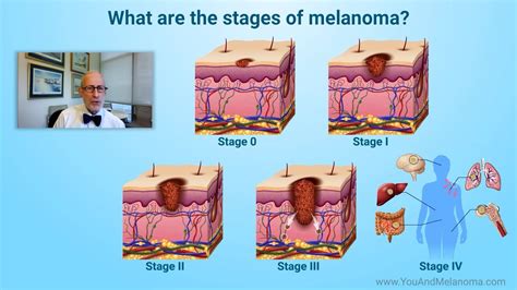 Melanoma Stage 0