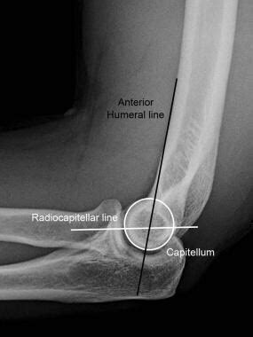 Imaging of Elbow Fractures and Dislocations in Adults: Overview, Radiography, Computed Tomography