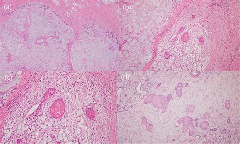 Representative microscopic features of necrotizing sialometaplasia in ...