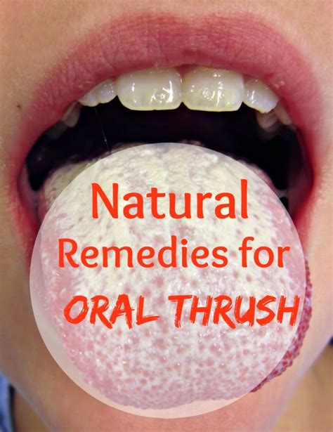 Natural Remedies for Oral Thrush | HealthMix Info