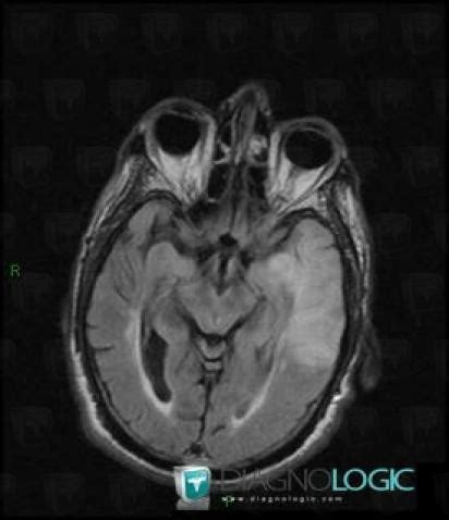 Radiology case : Cerebral infarction (MRI) - Diagnologic