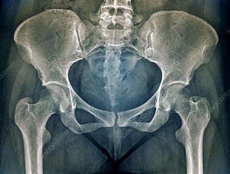 Female pelvis bones and joints, X-ray - Stock Image - C033/7355 ...