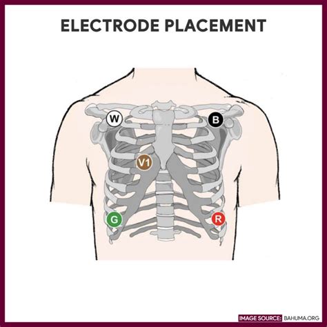 Holter Monitoring - Nursing Responsibilities and Care Plan - Nurseslabs