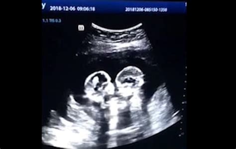 WATCH: Identical Twin Babies Shown on Ultrasound "Fighting" in the Womb - LifeNews.com