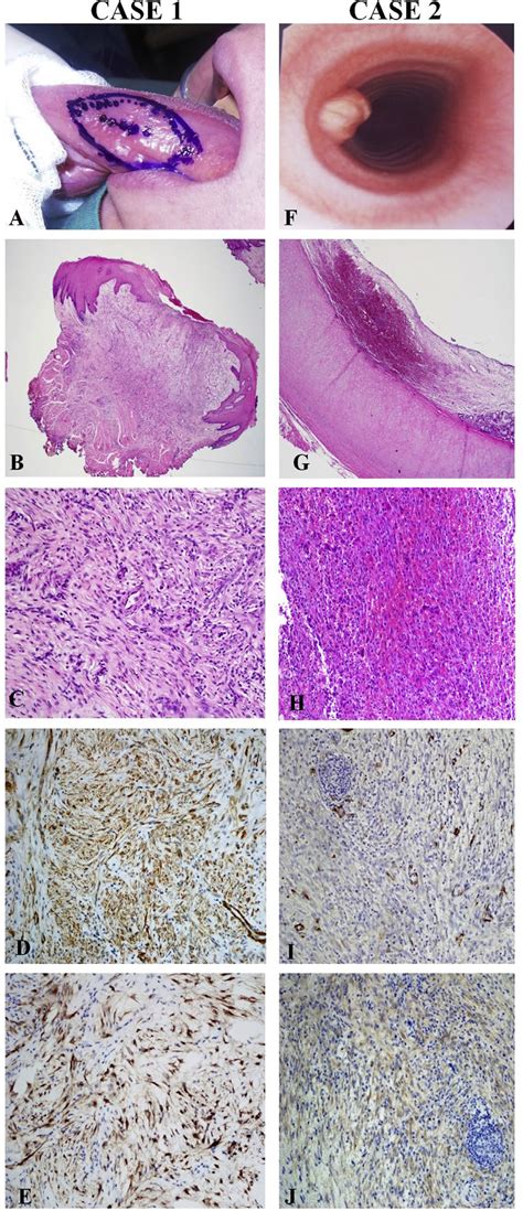 Case 1: (A) ulcer on tongue; (B) mucosal lesion with spindle cell ...