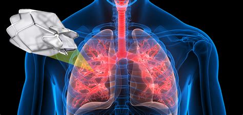 Zephyr® Endobronchial Valve | UT Health Athens