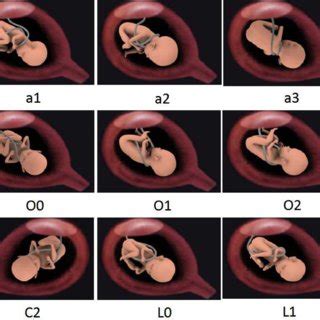 Model Figure of all types of nuchal cord. | Download Scientific Diagram