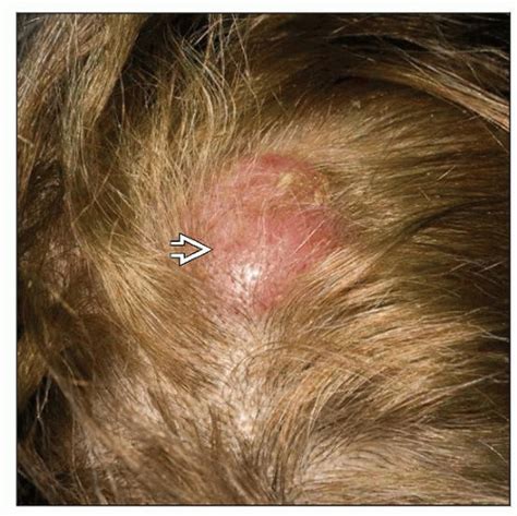 Primary Cutaneous Follicle Center Lymphoma | Basicmedical Key