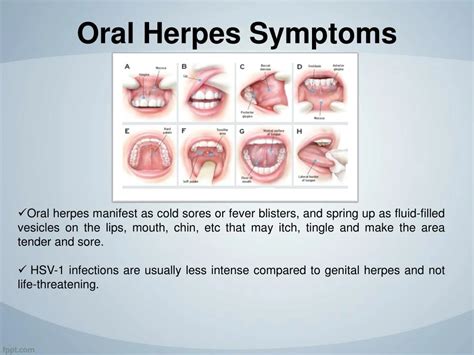 PPT - Oral Herpes: Symptoms, Causes & How to get rid of Cold Sores Naturally in 2018 - Biogetica ...