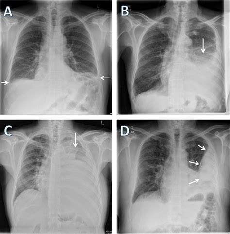 Loculated Pleural Effusion / 3 The Pleura / In a subgroup of patients ...