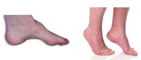 Equinus Deformity - Paragon Orthotic Laboratory