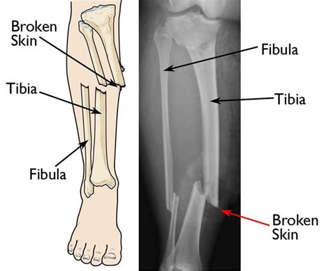 Illustration and x-ray show an open fracture | Open fracture, Broken bone, Fractures