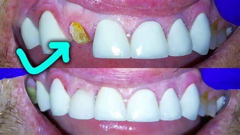 Broken Front Tooth Repair By A Dentist! How to Fix a Crown Fractured at Gumline! - YouTube