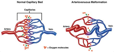 Arterio-venous Malformations (AVMs) - Memphis Vascular Center