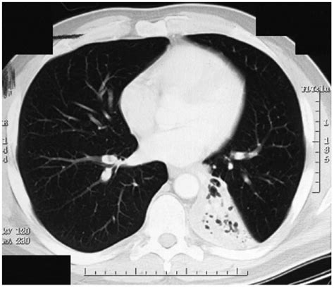 Mucoepidermoid Carcinoma | Thoracic Key